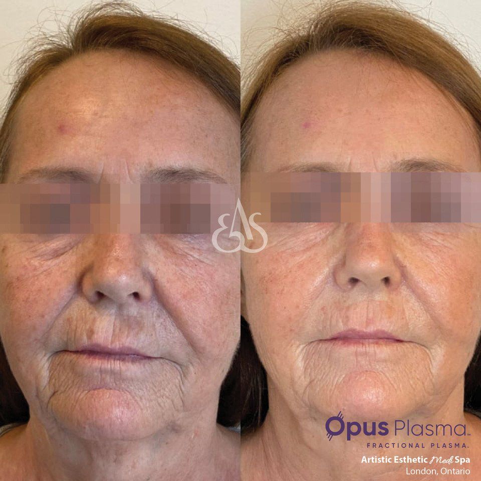 A before and after photo of a woman 's face.