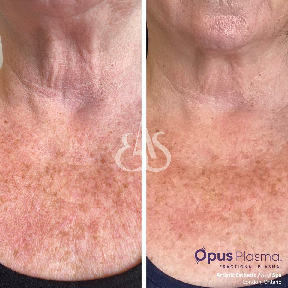 A before and after photo of a woman 's neck and chest.