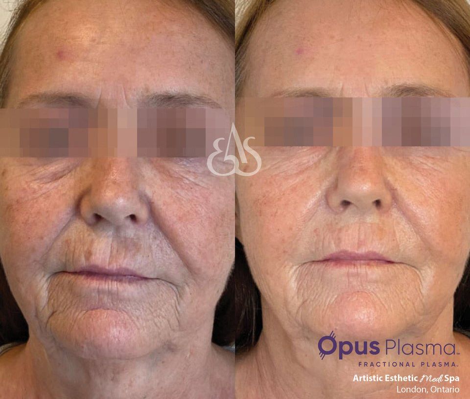 A before and after photo of a woman 's face.