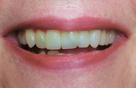 Not Cleaned Teeth — Topeka, KS — Today’s Dentistry