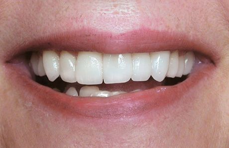 Cleaned Teeth — Topeka, KS — Today’s Dentistry