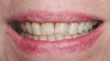 With Cavity — Topeka, KS — Today’s Dentistry