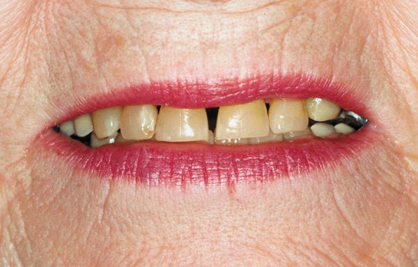 Yellowish Teeth — Topeka, KS — Today’s Dentistry