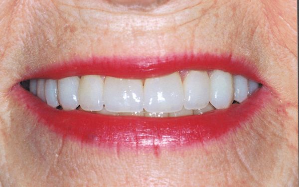 White Teeth — Topeka, KS — Today’s Dentistry