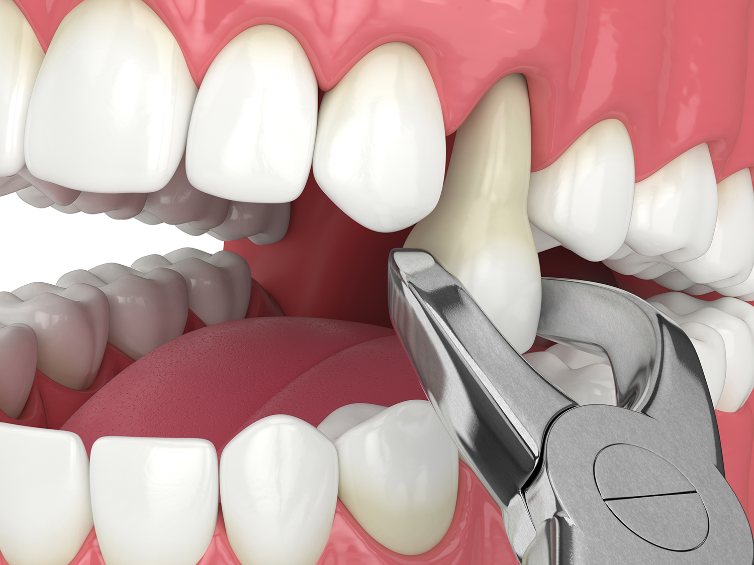 closeup model of a tooth extraction not showing any blood just a tooth barely coming out of a model mouth