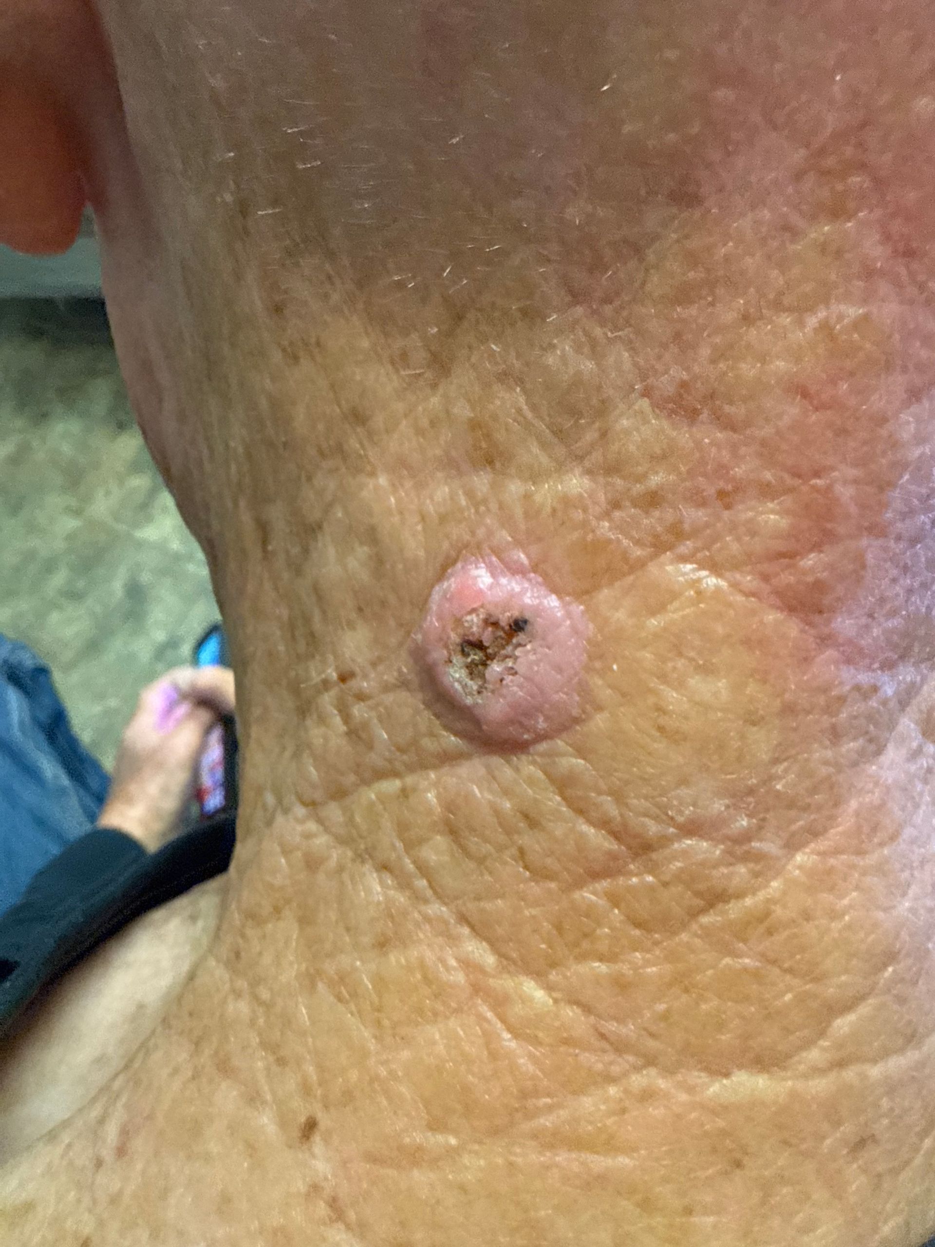 A close up of a person 's neck with a small bump on it.