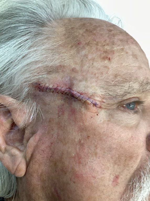 A close up of an elderly man 's face with a stitch on his forehead.
