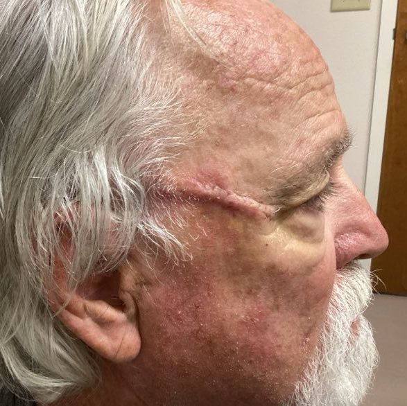 A man with a beard has a scar on his forehead.