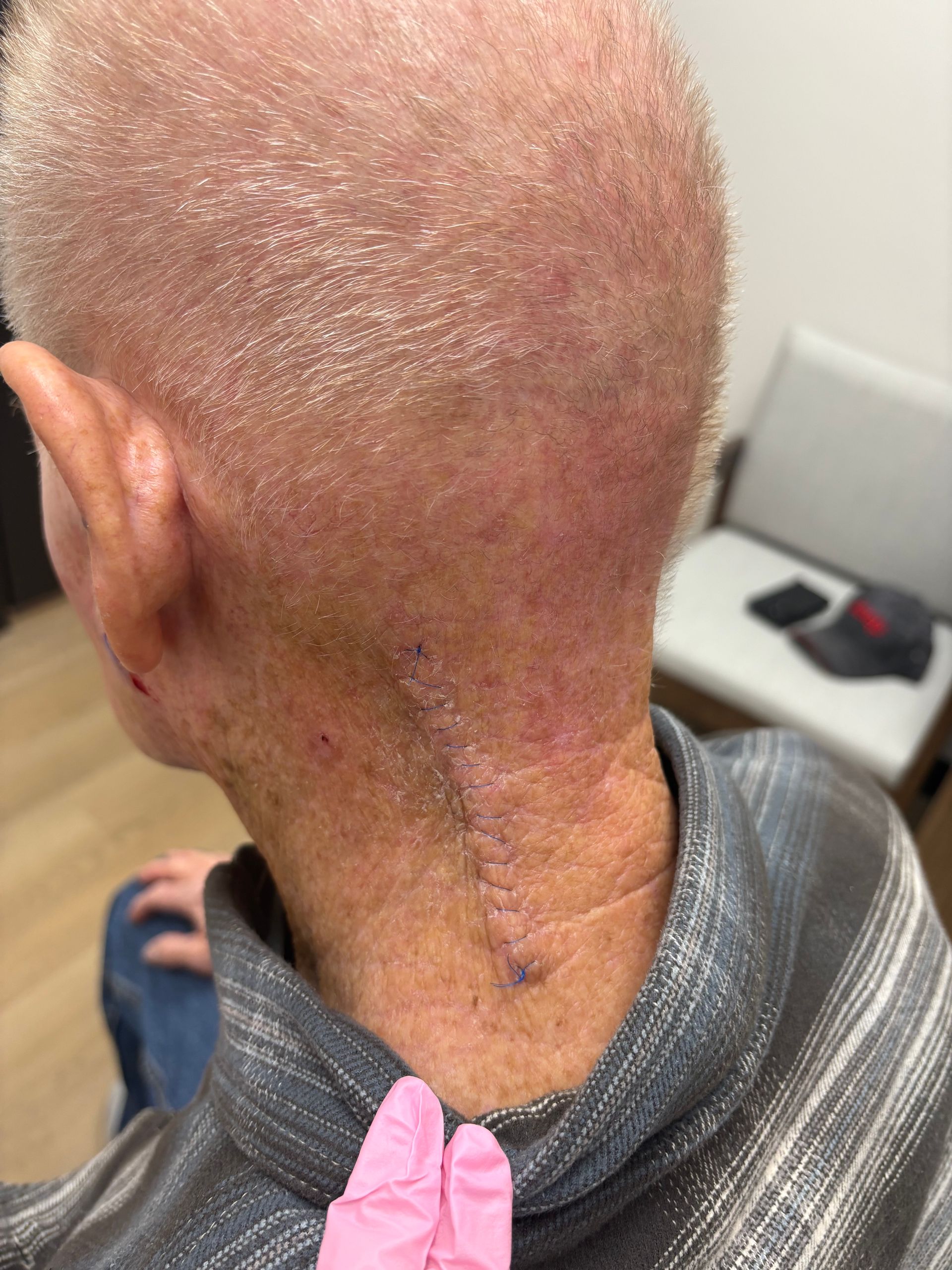 A close up of a person 's head and neck with a surgical scar.