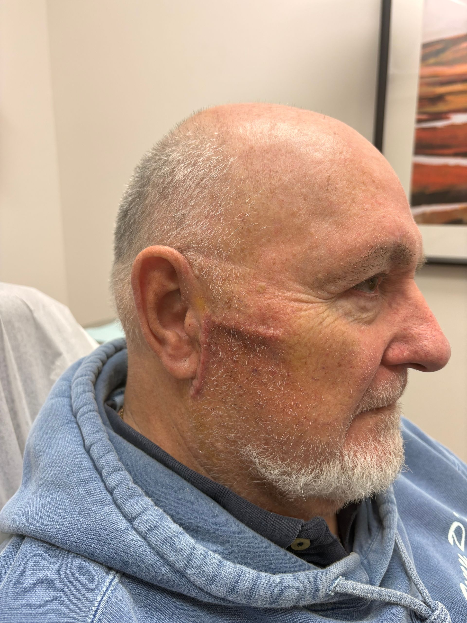 A man with a beard and a scar on his face is wearing a blue hoodie.