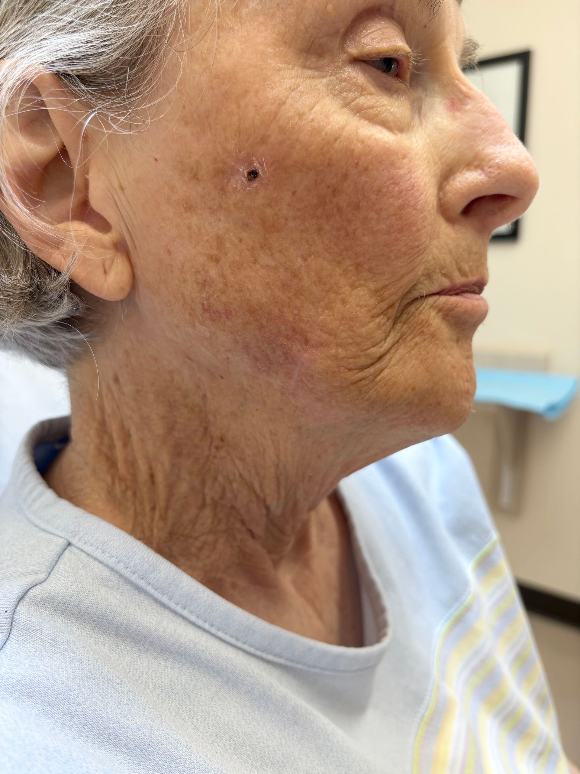 An elderly woman with a black spot on her face is sitting in a hospital bed.