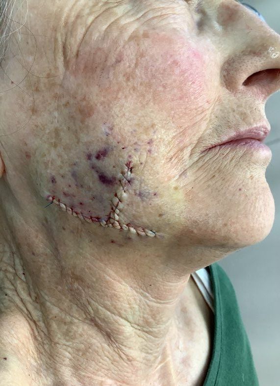 A close up of an older woman 's face with stitches on it.