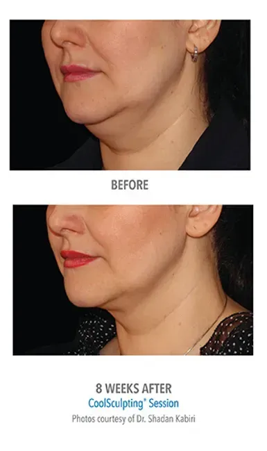 Before Cool Sculpting treatment