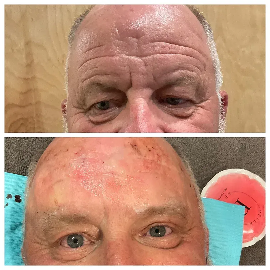 a before and after photo of a man 's face with PDO thread lift procedure at Pelle Spa