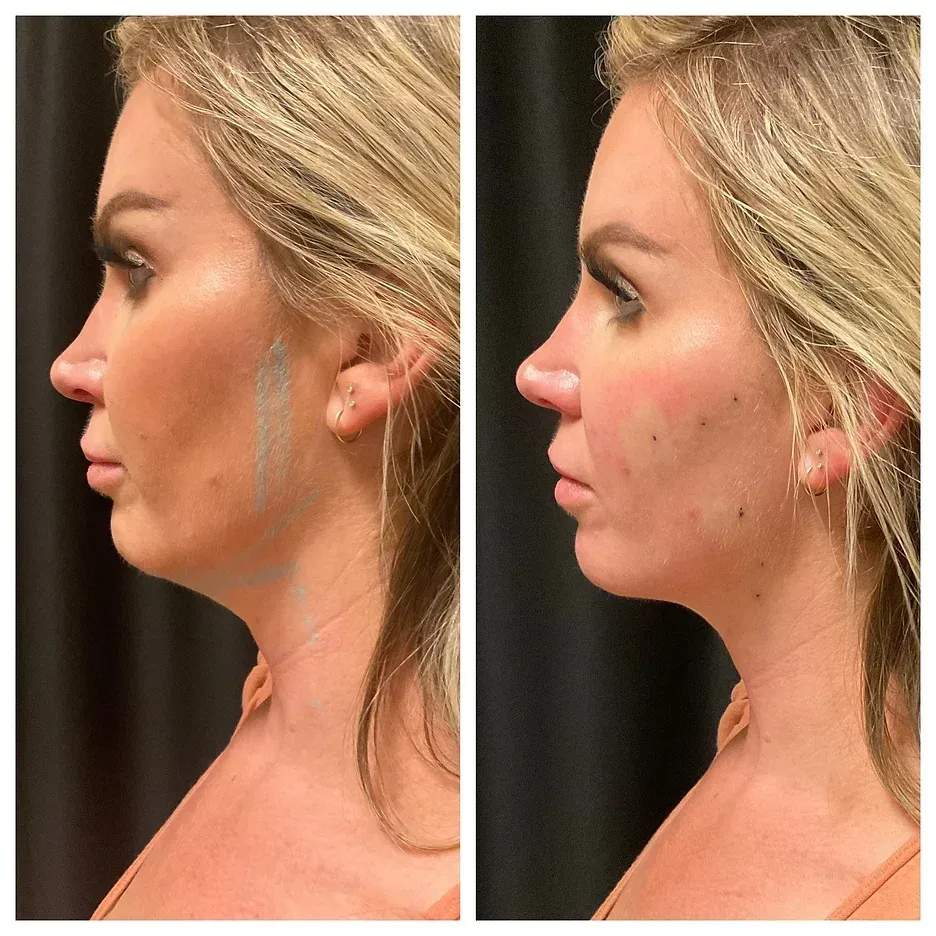 a before and after photo of a woman 's face lift procedure offered at Pelle Spa