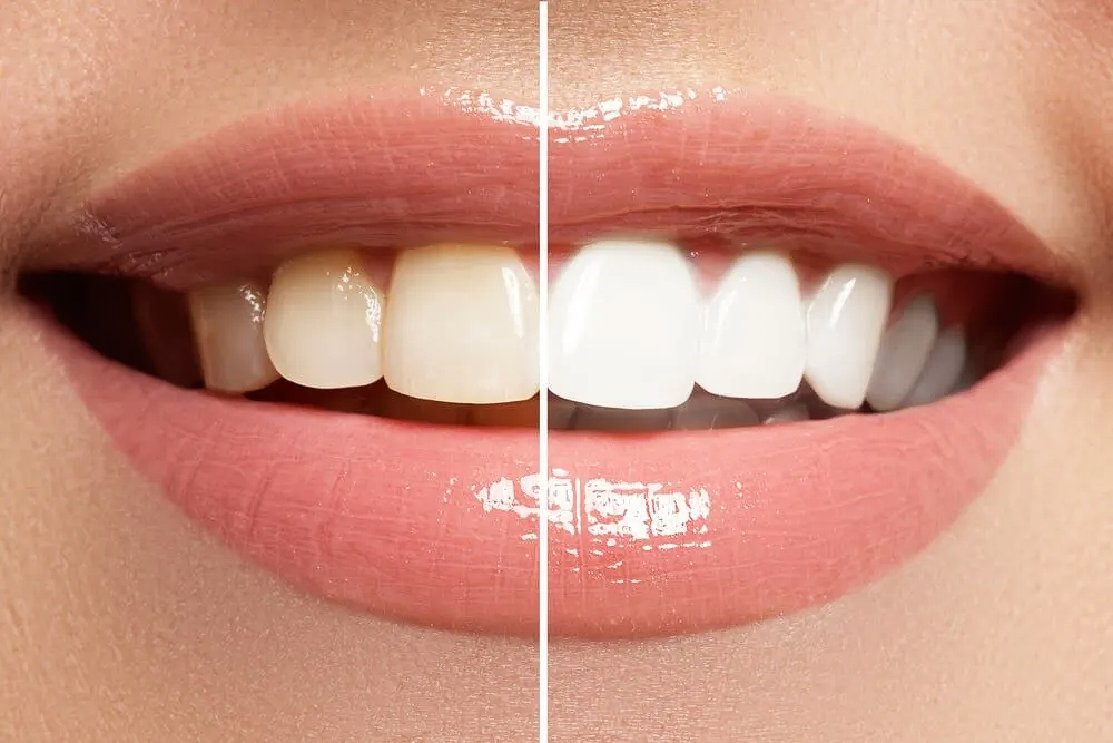 Before and After Teeth Whitening — Dental Services in Gympie, QLD