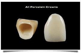 NHS dentist - Kent - Chatham Dental Surgery - porcelain crown	