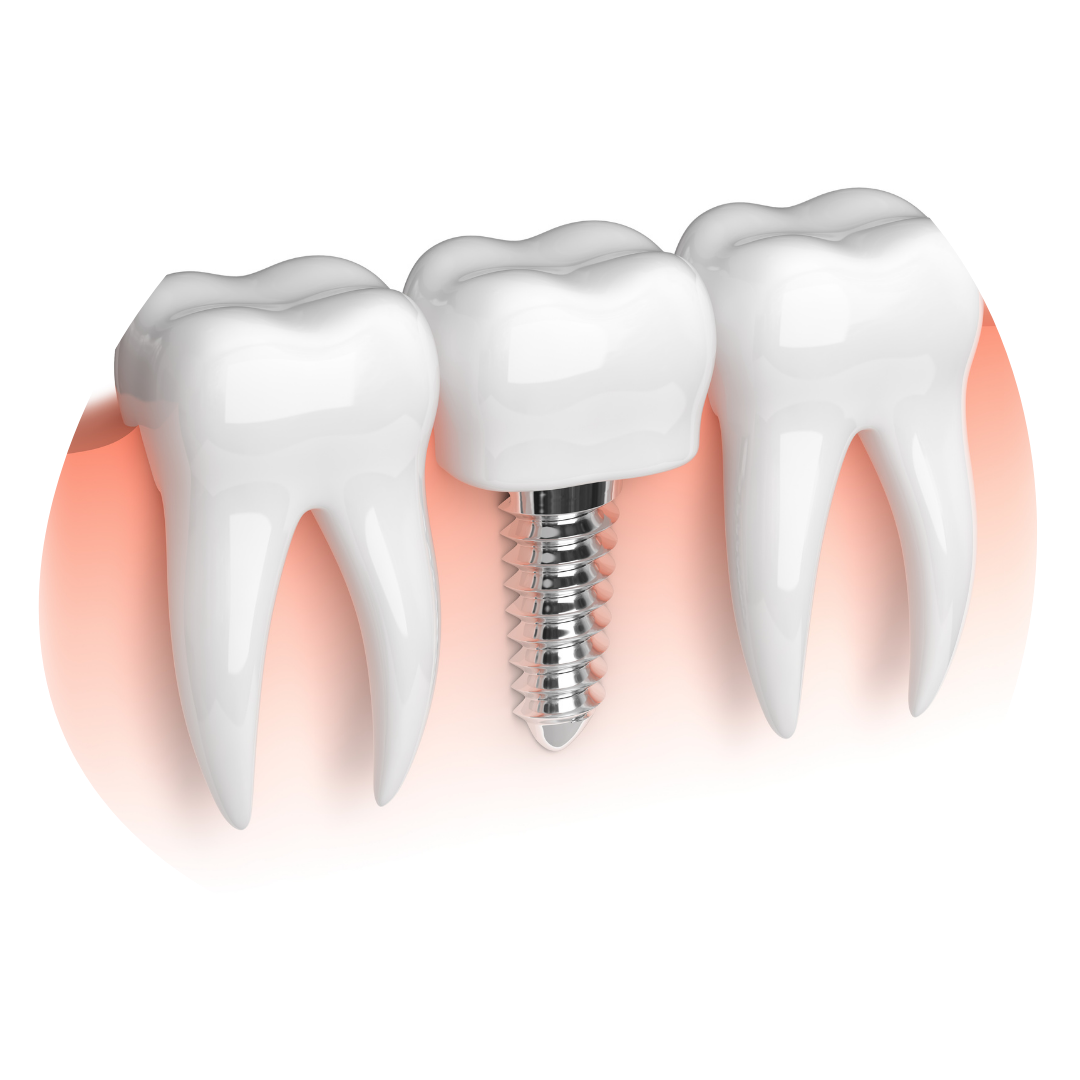 A 3D rendering of a dental implant in a tooth.