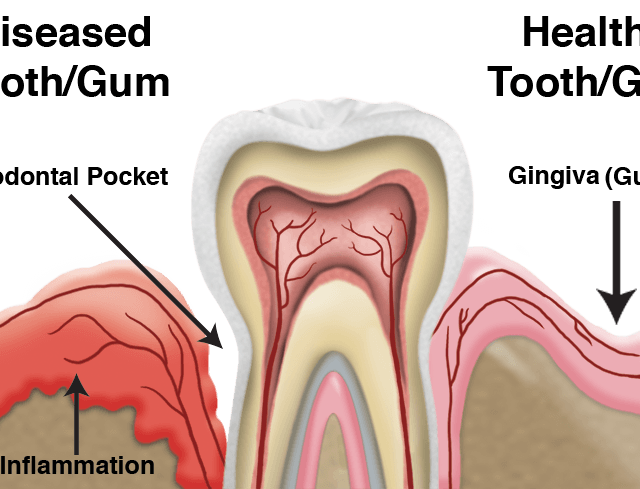 A diagram of a tooth showing inflammation and health tooth