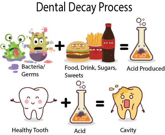 A cartoon illustration of the dental decay process