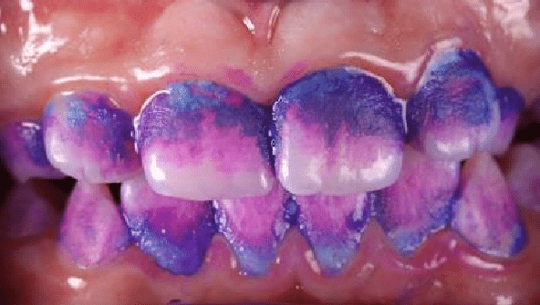 A close up of a person's teeth with purple and blue stains on them.