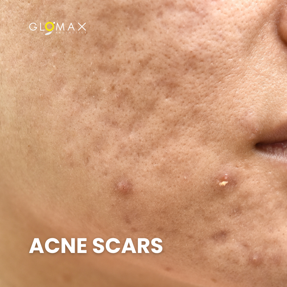 With advancements in dermatology, there's a range of effective treatments to address acne scars.