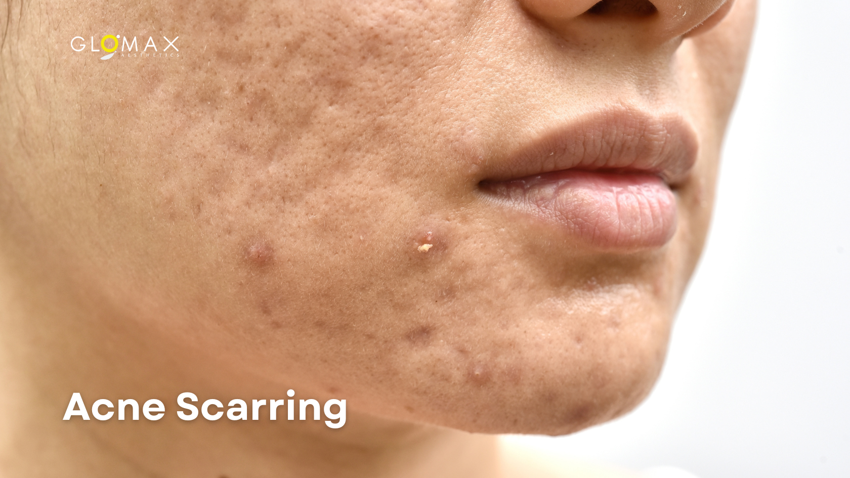 With advancements in dermatology, there's a range of effective treatments to address acne scars.