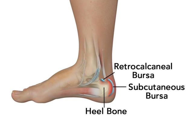Retrocalcaneal Achilles Tendinopathy And Bursitis Heel Pain