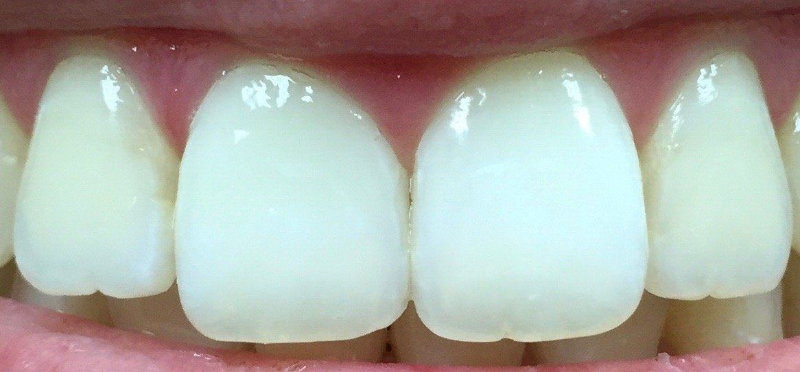 After Resin Infiltration - Dental Studio 4 Kids Lutz Florida