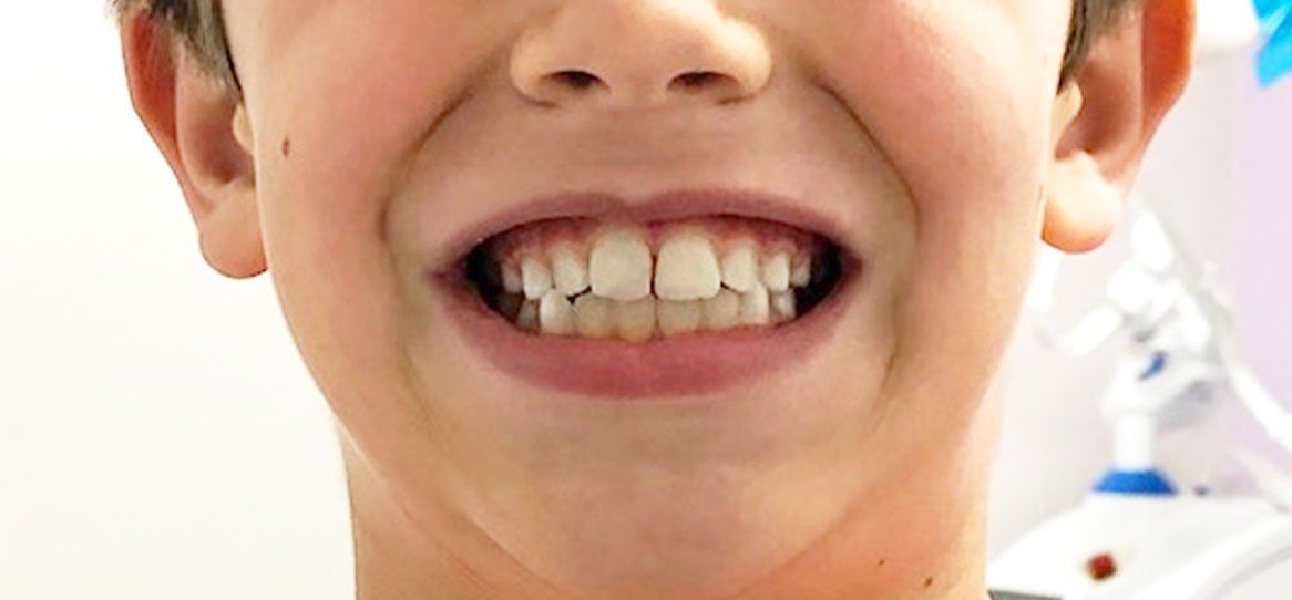 A close up of a young boy 's mouth with his teeth showing.