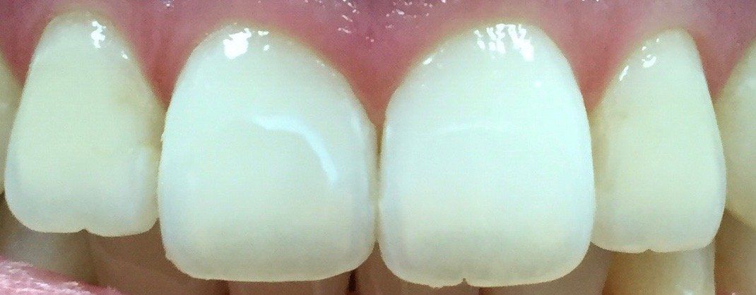 Before Resin Infiltration - Dental Studio 4 Kids Lutz Florida