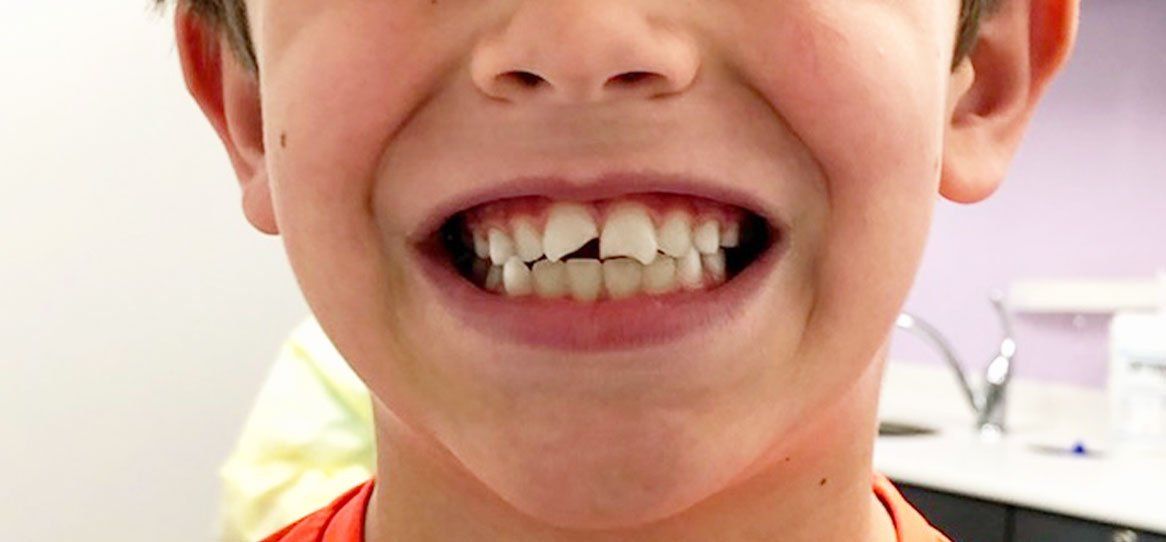 A close up of a young boy 's mouth with his teeth showing.