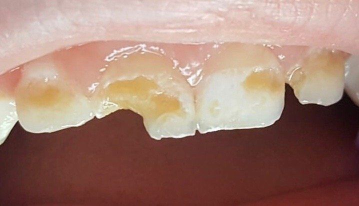 Before Zirconia Crowns