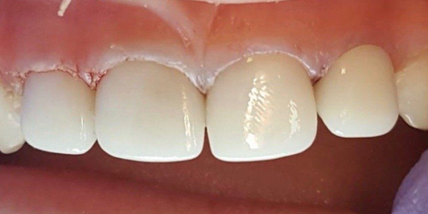 After Zirconia Crowns