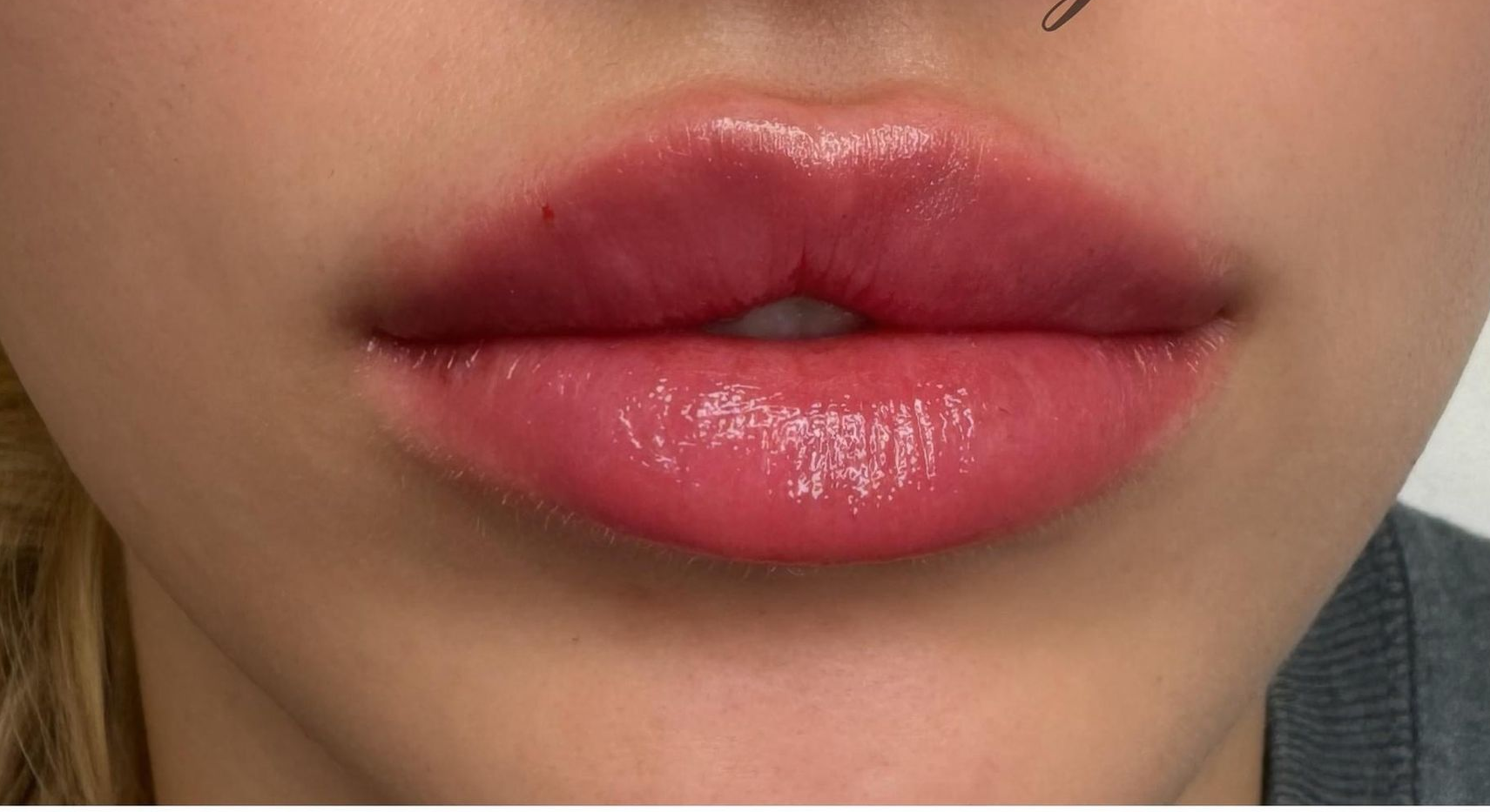 Close-up of a person's lips. The lips are full, glossy, and a rosy pink hue, possibly after a cosmetic procedure.