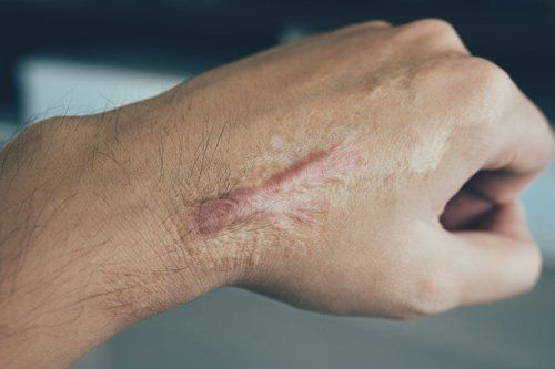 Scar On Arm — Placentia, CA — Law Offices of Kennith L. Peterson