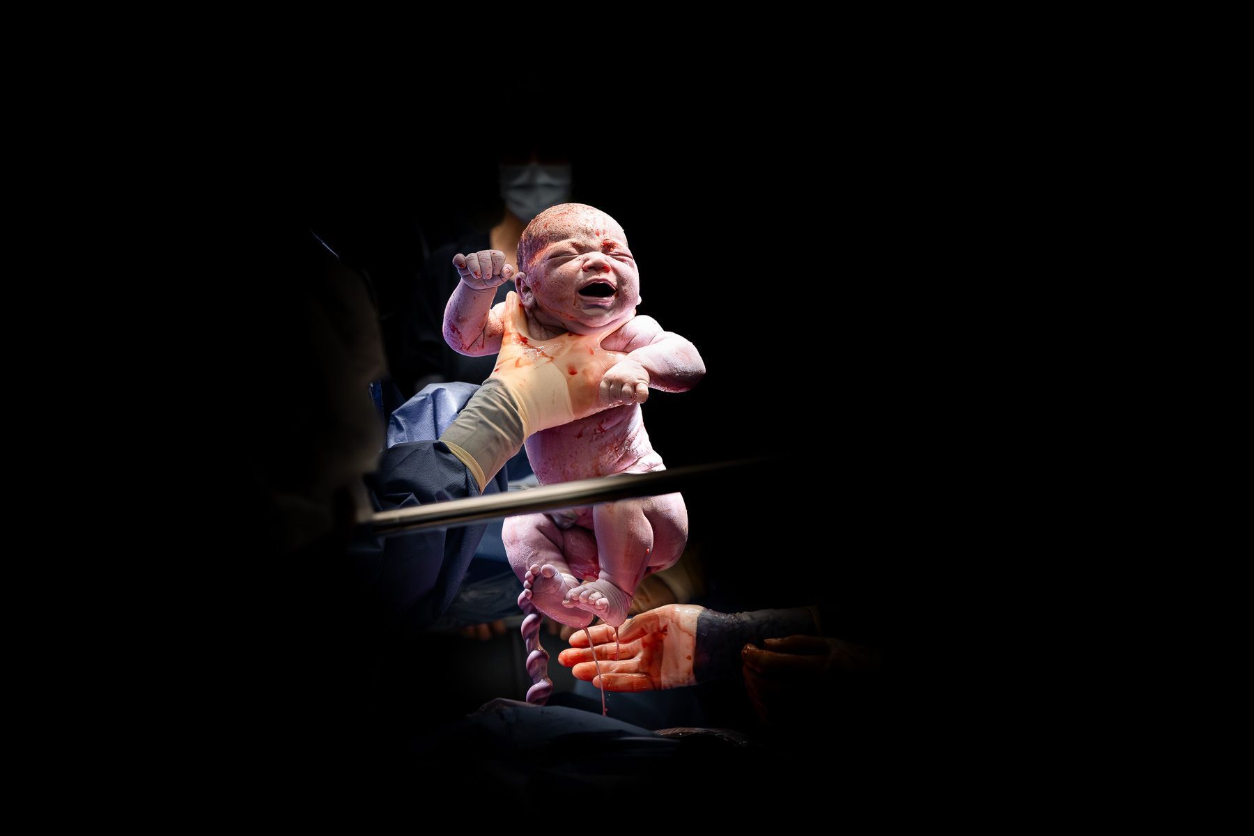 Pasgeboren baby wordt omhoog gehouden direct na de geboorte via een keizersnede in de operatiekamer.