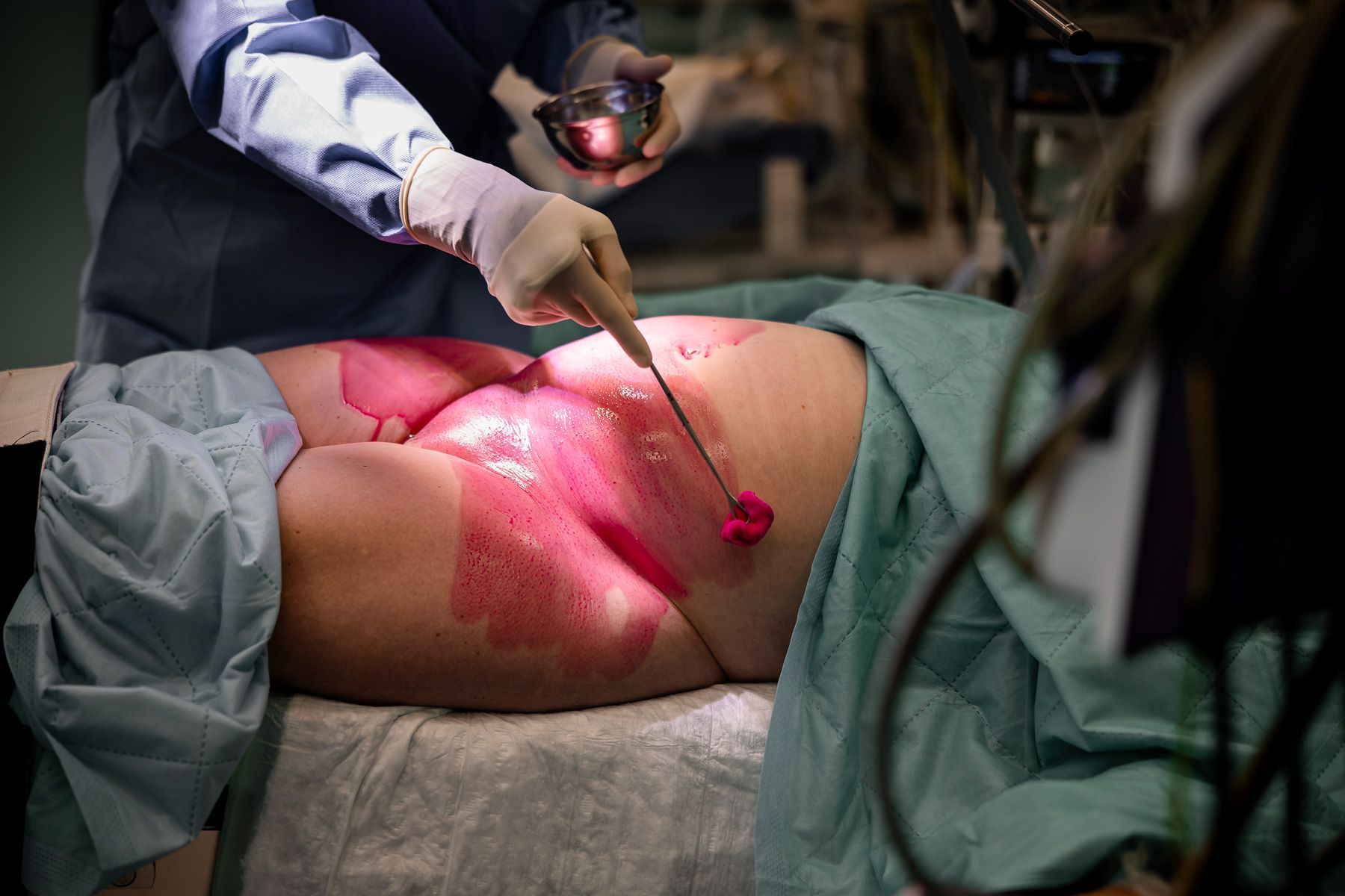 Buik van de moeder wordt gedesinfecteerd ter voorbereiding op een keizersnede in de operatiekamer.