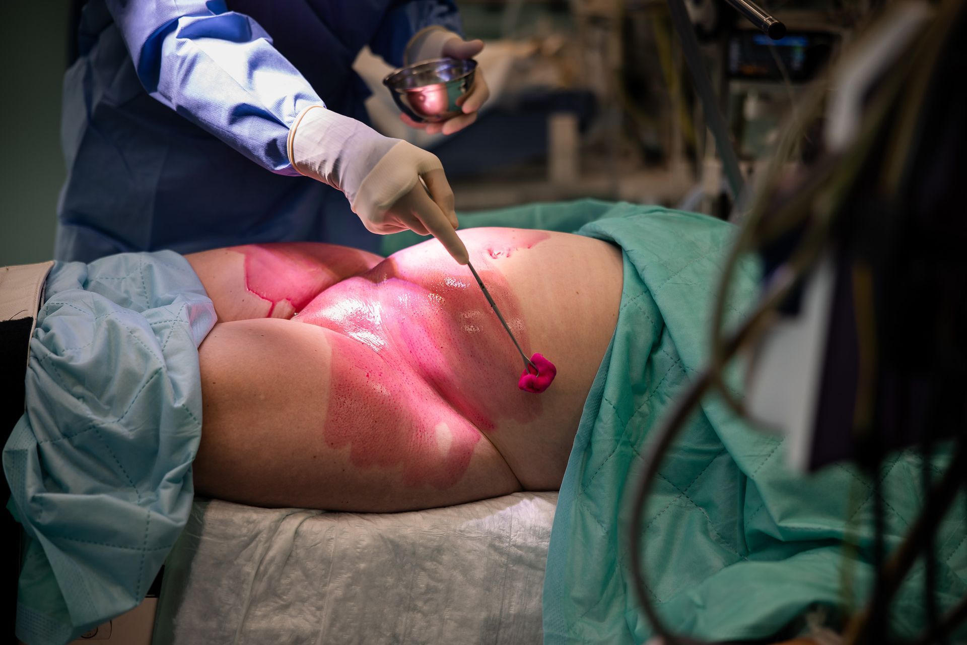 Voorbereiding van de buik tijdens een keizersnede in het ziekenhuis, zorgvuldig vastgelegd door een geboortefotograaf