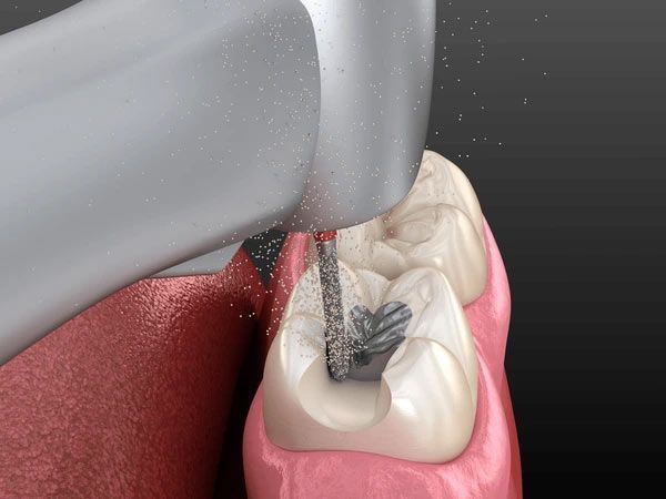 A close up of a tooth being drilled with a drill.