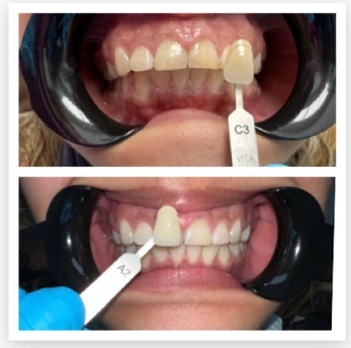 A woman 's teeth are shown before and after whitening