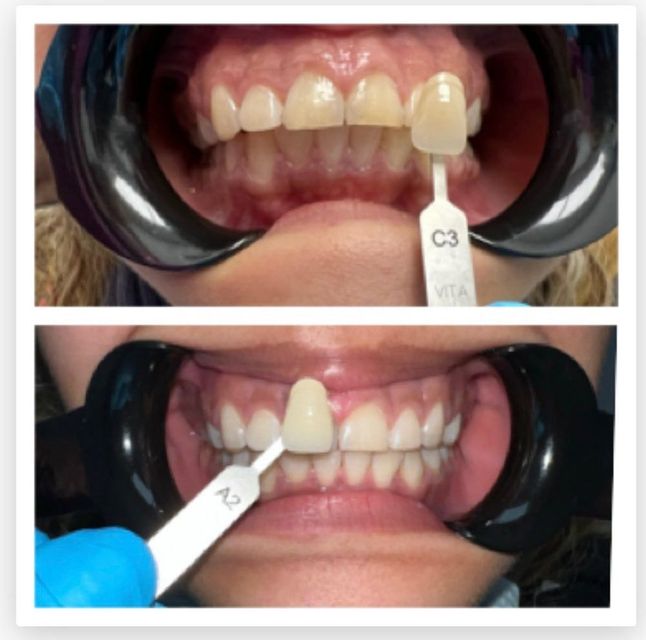 A woman 's teeth are shown before and after whitening
