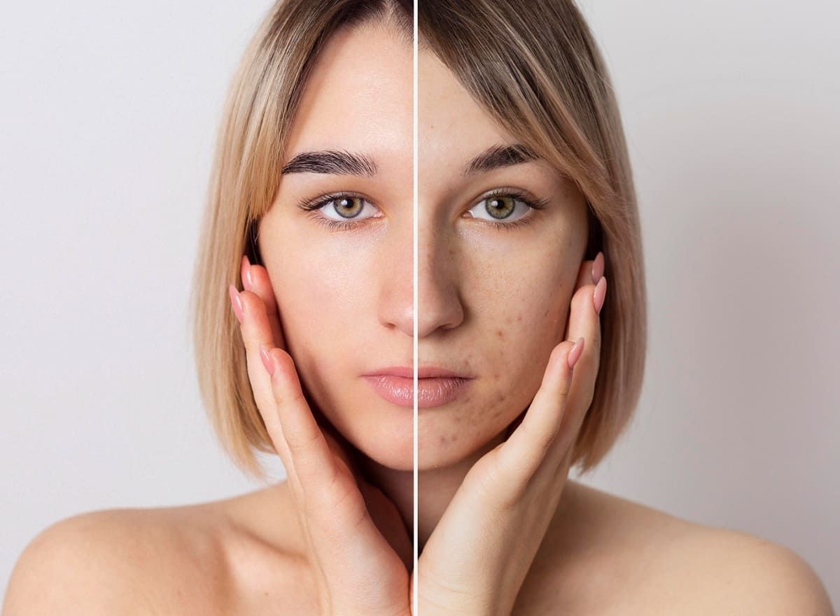 Microneedling and PRP near me