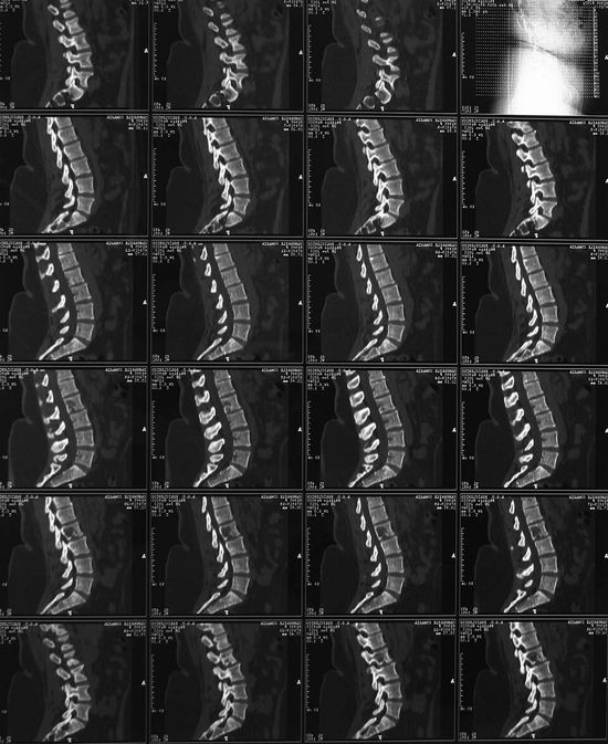 varie prospettive radiografiche della colonna vertebrale