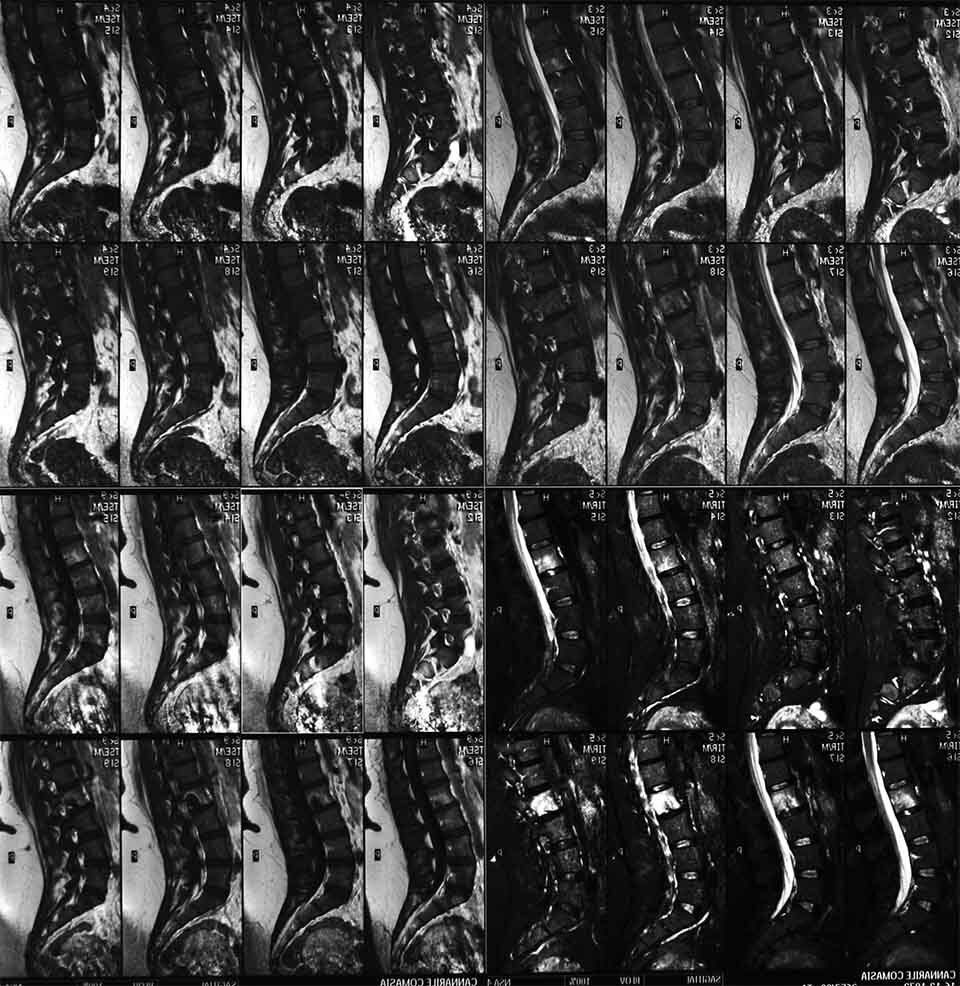 radiografia evidenzia frattura vertebrale