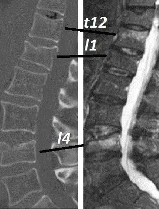 radiografia frattura vertebrale