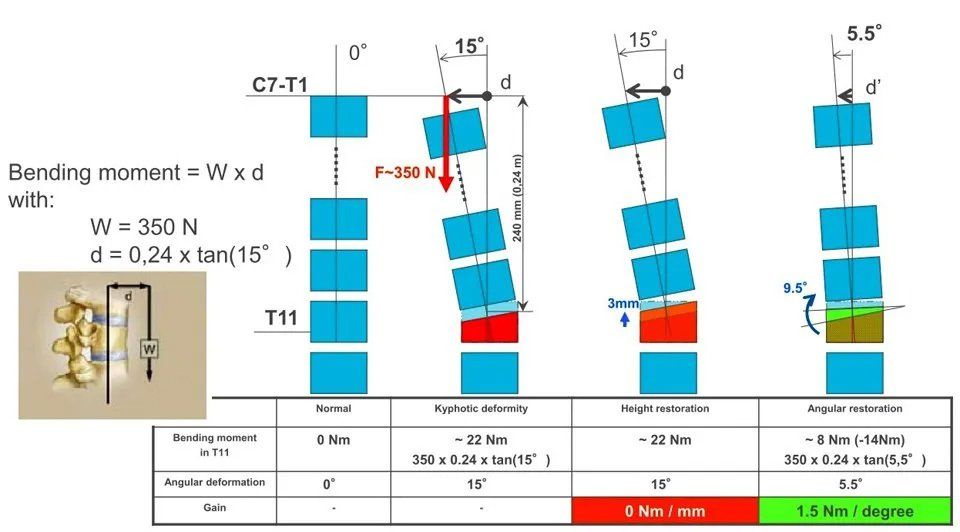 Fratture vertebrali da osteoporosi