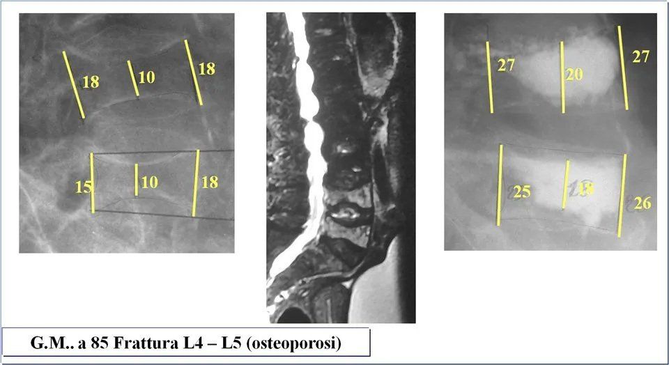 studio fratture vertebrali
