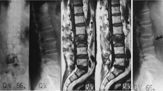 movimento flessorio colonna vertebrale