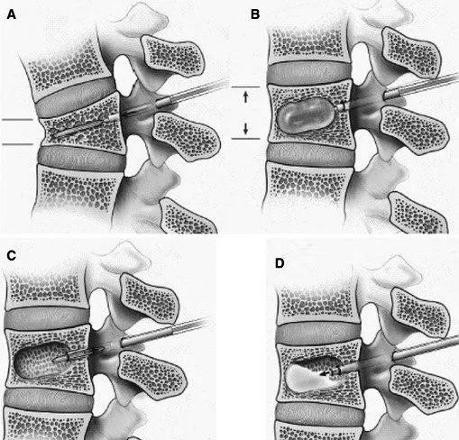 intervento per problematiche dell'osteoporosi